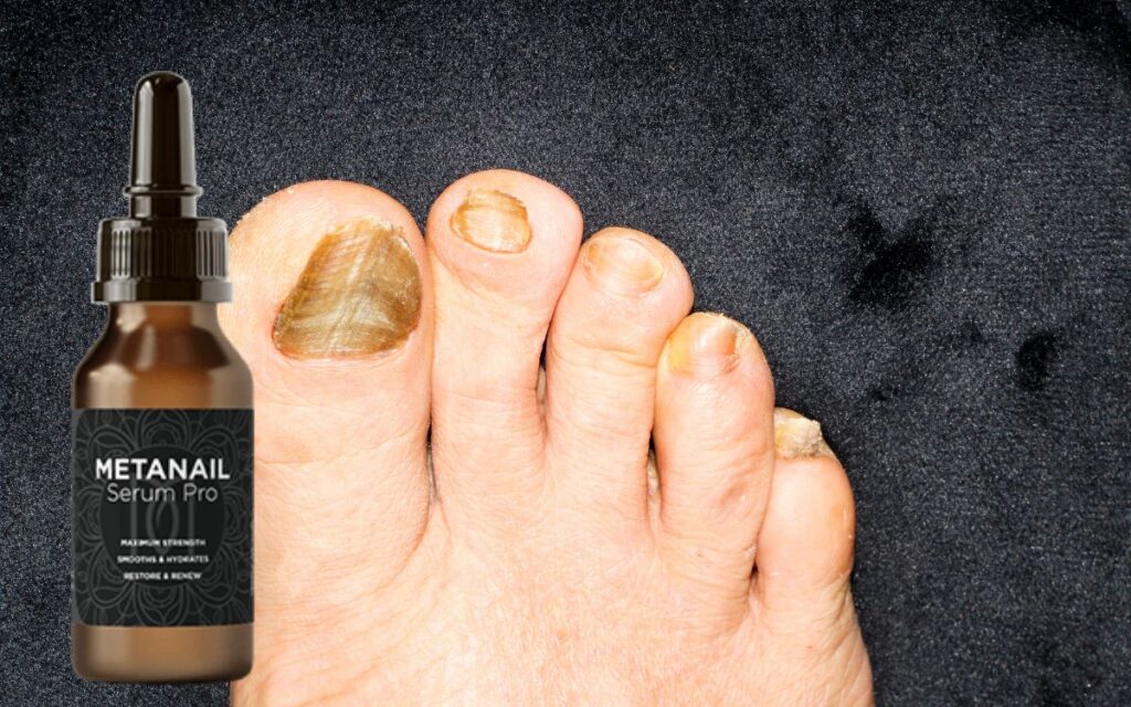 Metanail Serum Pro: Scam?